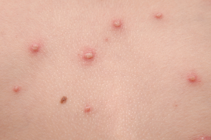 pics of chickenpox